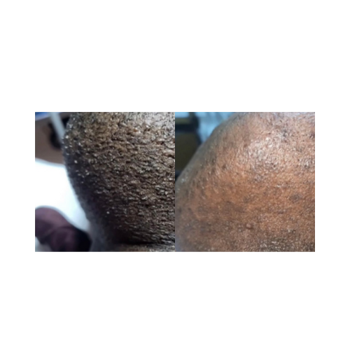 Long-term hair reduction across all skin tones with Cervello