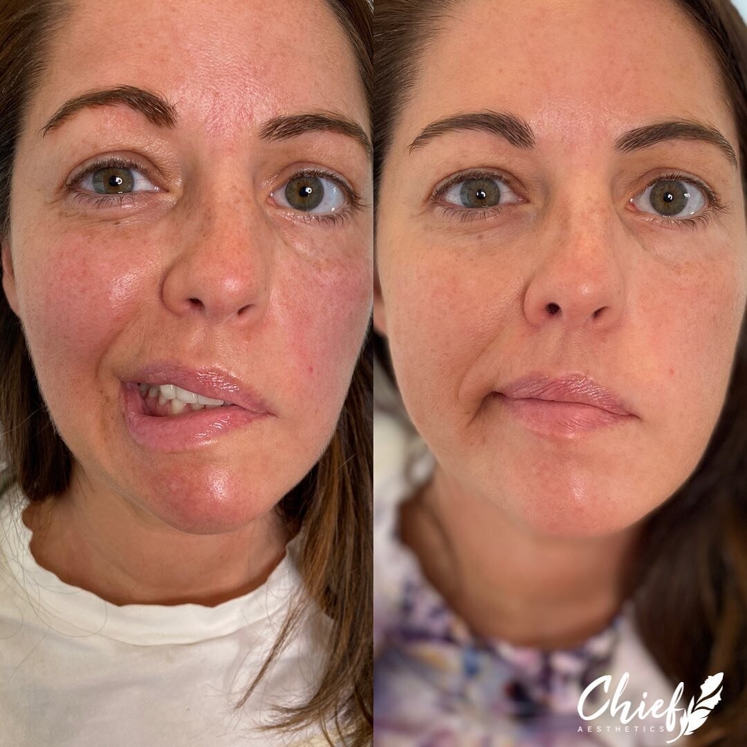aesthetic-symmetry-reduced-facial-tension-Chief-Aesthetics-Western-NY-7