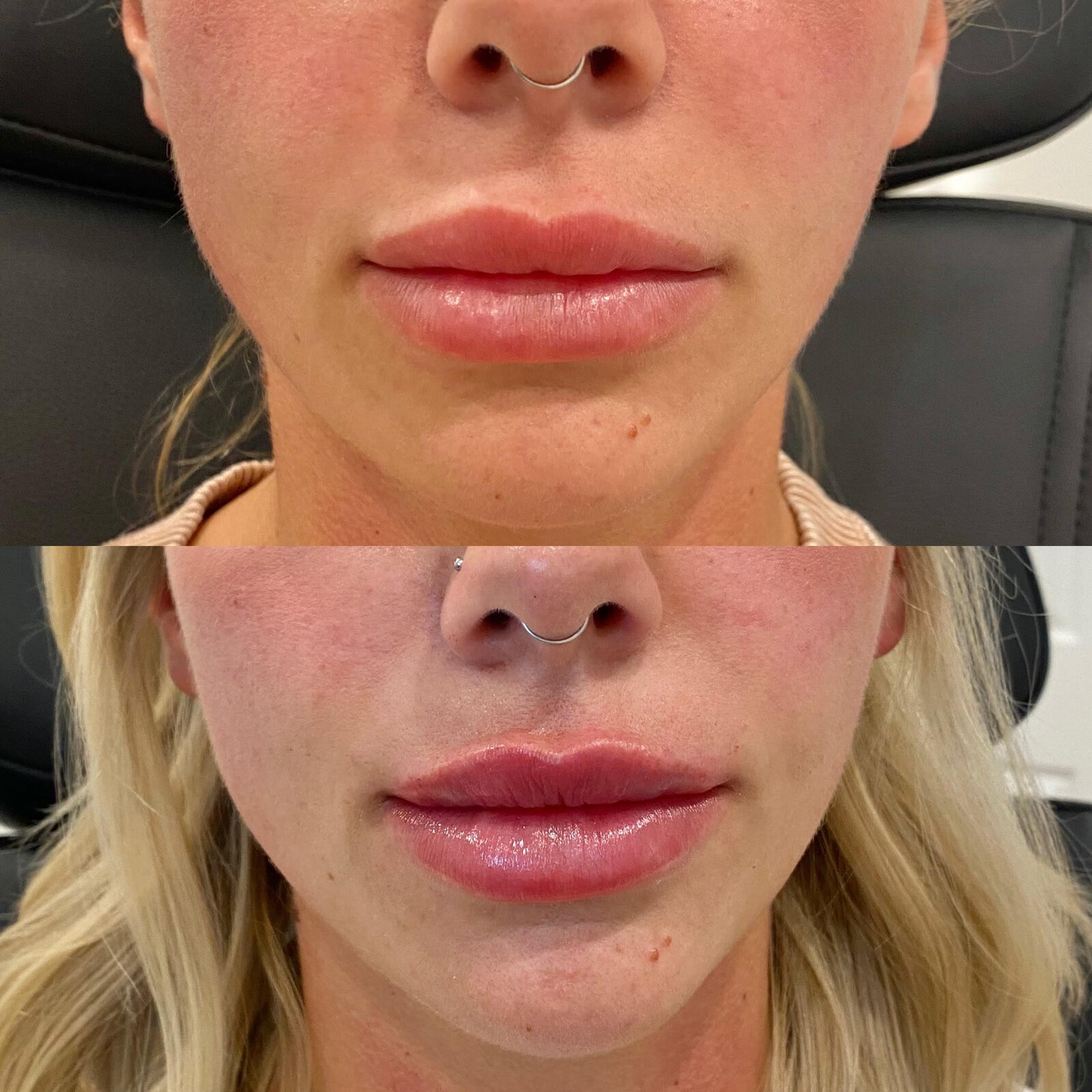 canova-lip-injections-before-after