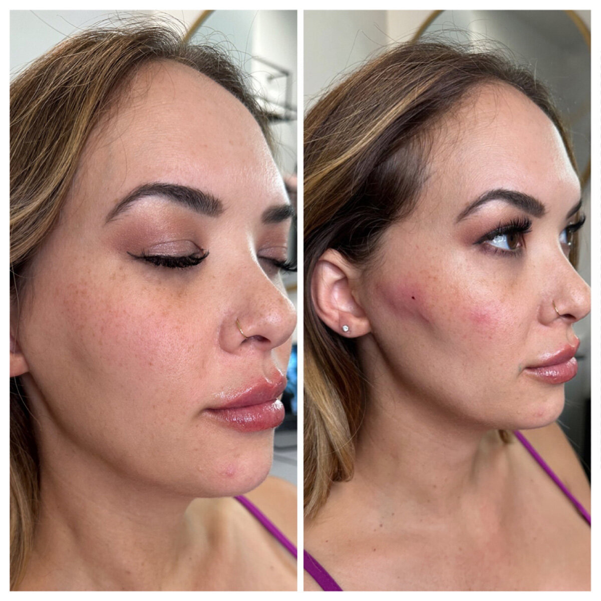 W Aesthetics Dermal Fillers Before and After. Austin Texas 2