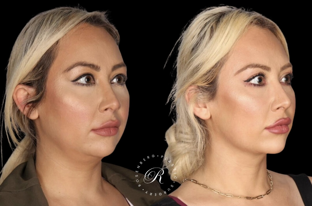 Neck Lipo RPS Before & After.zip - 12