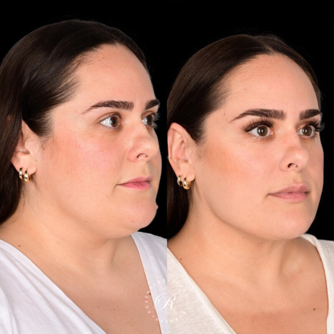 Neck Lipo RPS Before & After.zip - 10