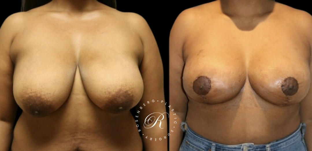 Breast Lift & Reduction RPS Before & Afters.zip - 93