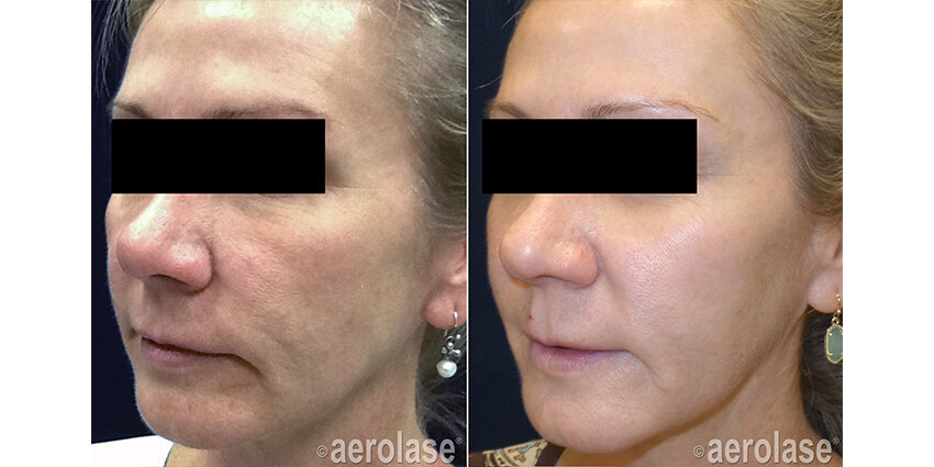 Neo Rejuvenation - After 4 Treatments - Kevin Pinski MD