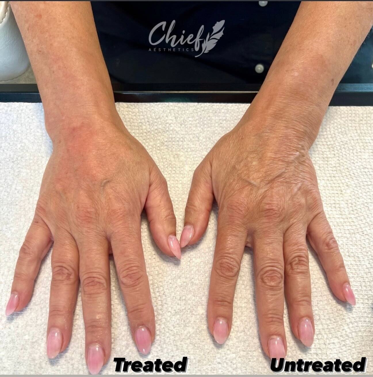 Hand-Rejuvination-using-Radiesse-chief-aesthetics-buffalo-ny