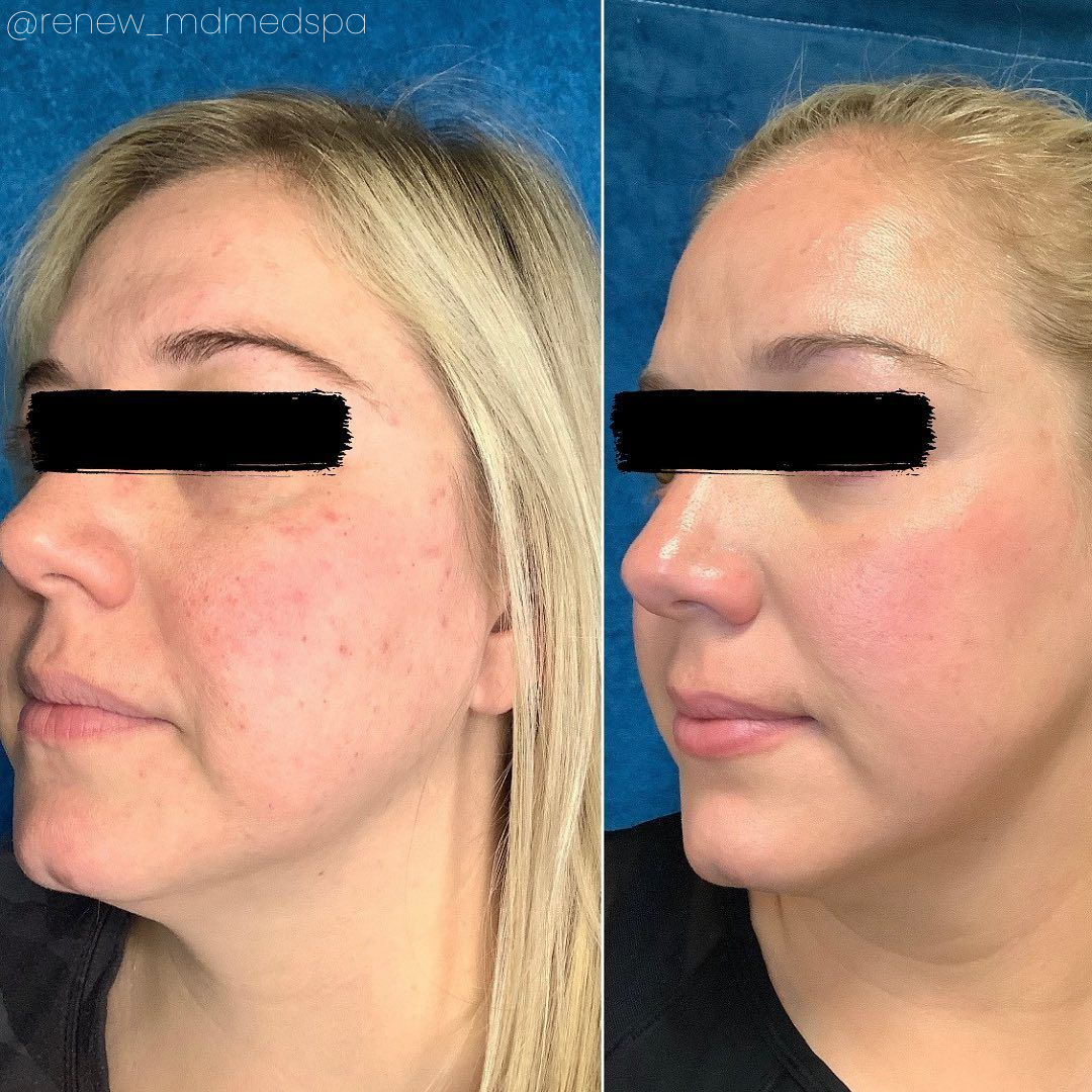 Neo Elite® - NeoSkin® - Skin Rejuvenation (3)