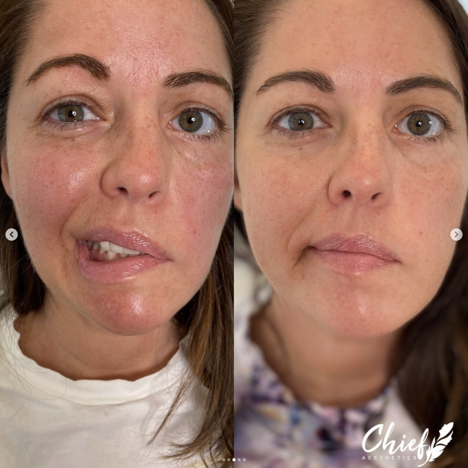 aesthetic-symmetry-reduced-facial-tension-Chief-Aesthetics-Western-NY-3