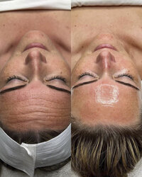 cleveland hydrafacial results example