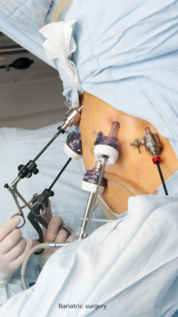 bariatric surgery
