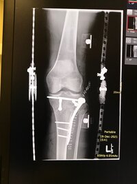 X-ray image of broken leg from falling off of a horse.