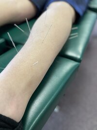 Dr. Lauren providing Dry needling care in Sterling IL