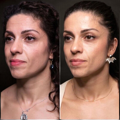 Upper Face lift
