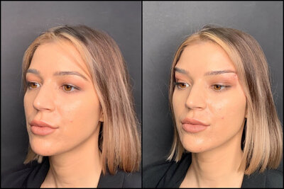 fox eye thread lift _ before-immediately after