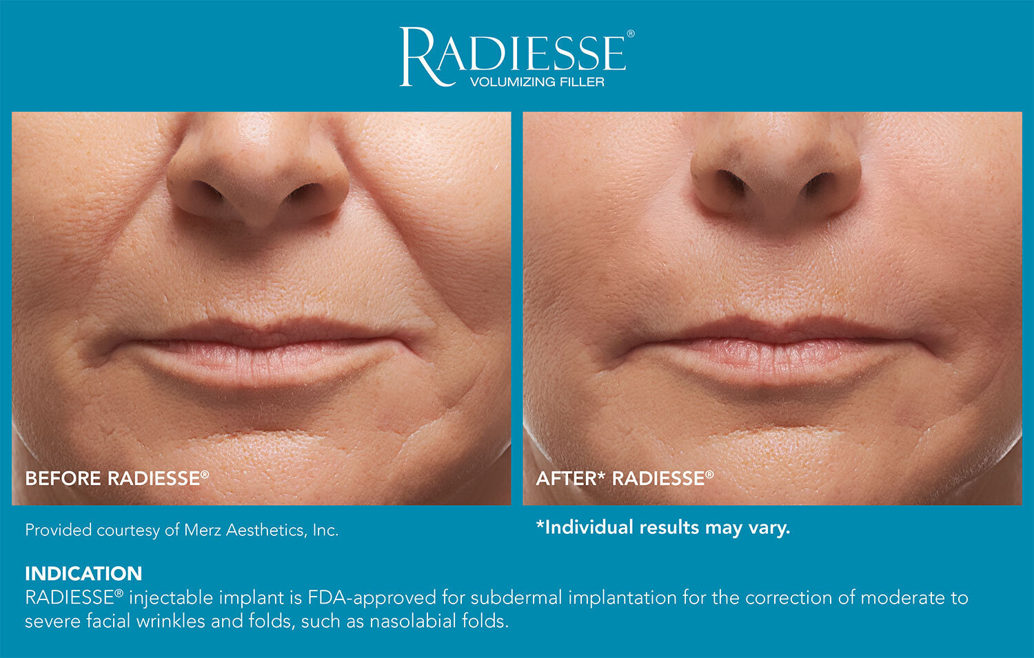 RadiesseBefore&After-0