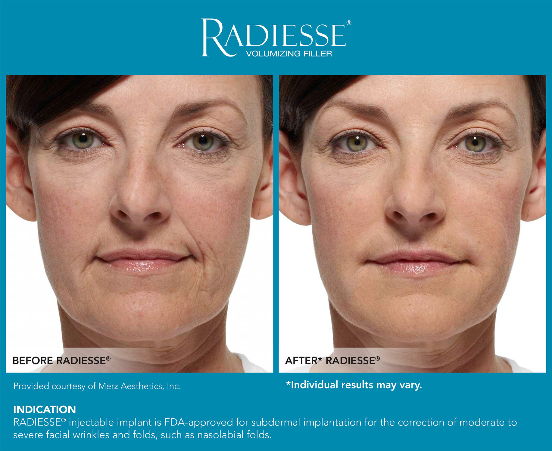 RadiesseBefore&After-0-2