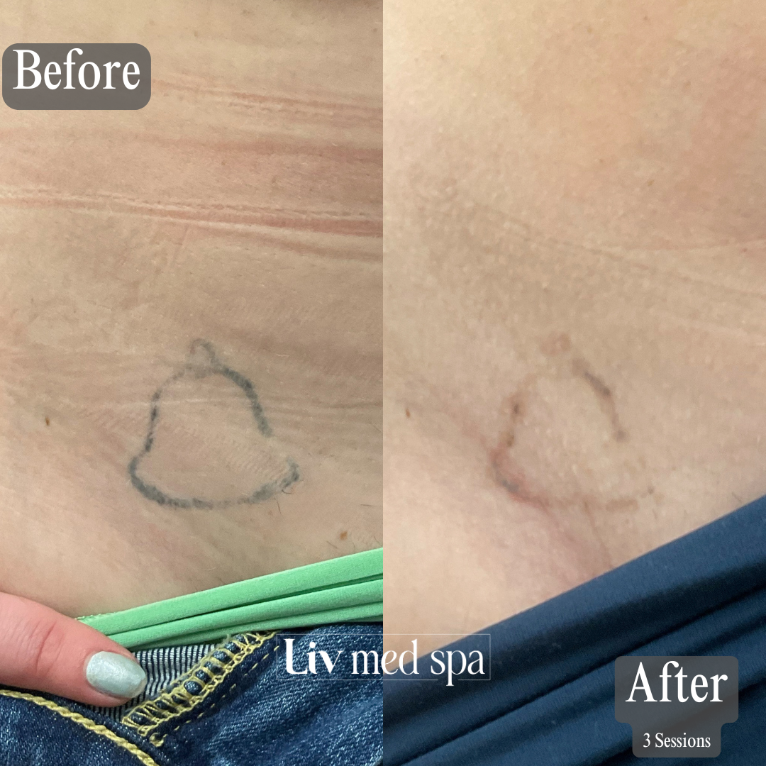 Eyebrow Before & Afters