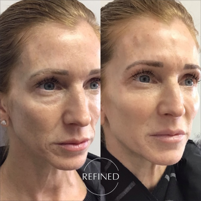 Dermal filler full face