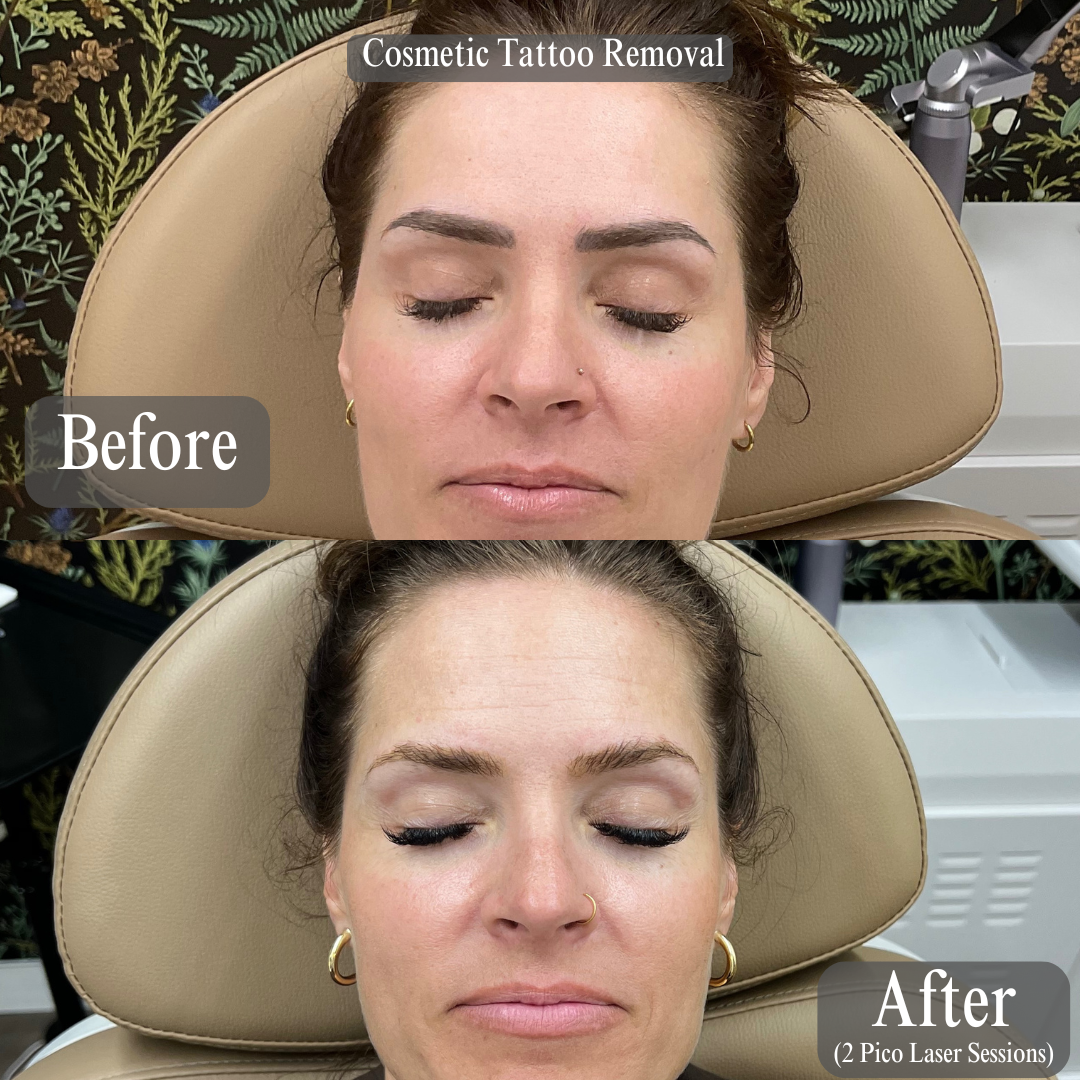 Tattoo B&A