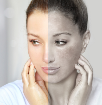 image of a woman's face divided in half showing one side with clear skin and one side with melasma