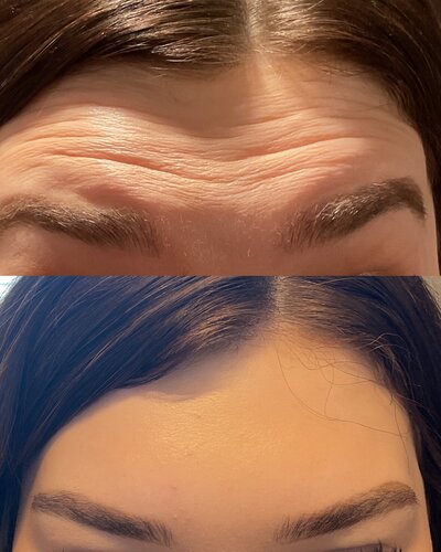 Dysport and Botox before and after