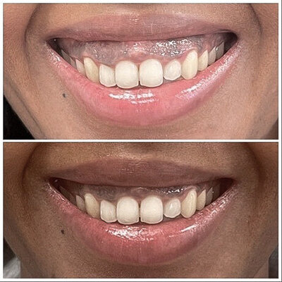 Botox gummysmile before after door cosmetisch arts Lizenka Adriaanse in Rotterdam