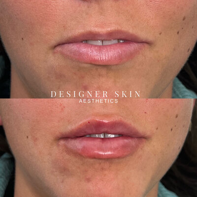Before and after lip filler treatment in Huntington Beach