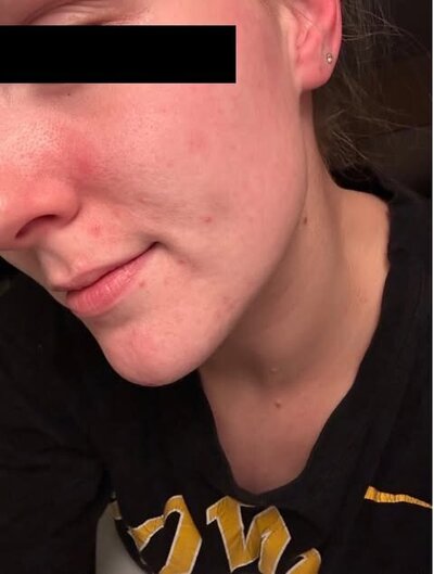 Client with cleared skin from clear skin diet