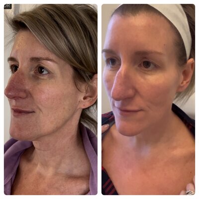 BBL laser session targeting sun damage and pigmentation at a Burlington med spa.