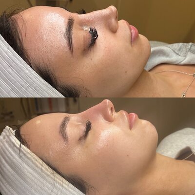 microneedling 3sessions.1 