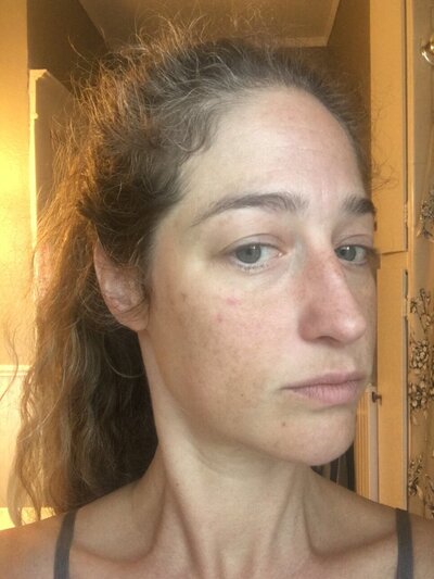 profile of a woman as melasma is fading on her cheek