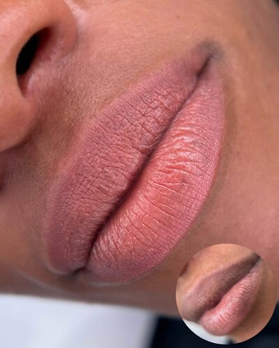 Healed Lip Neutralization