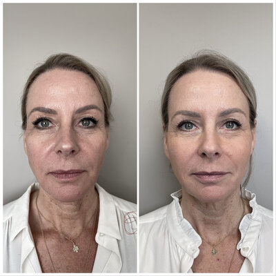 Before after liquid facelift Lizenka Adriaanse cosmetisch arts Rotterdam