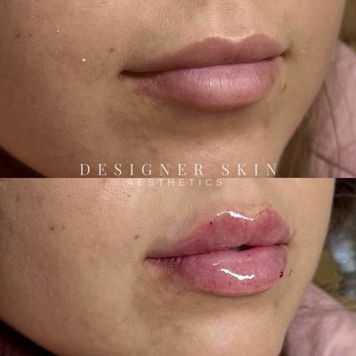 Before and after lip filler treatment in Huntington Beach