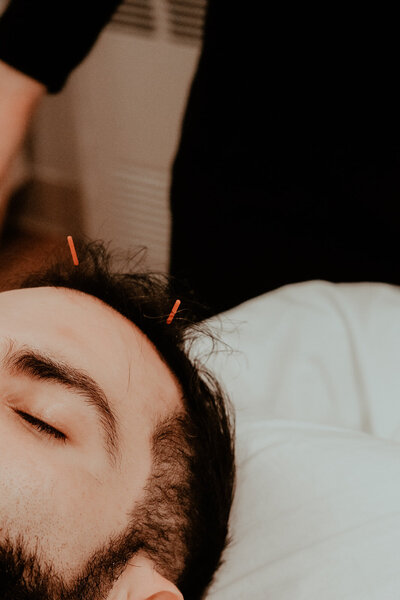 Male acupuncture patient with dark, short hair has two small needles in forehead as he sits atop acupuncture table.