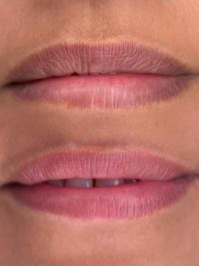 Healed Lip Neutralization New York