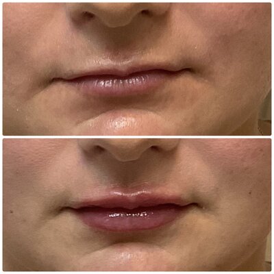 AS_lip filler_before & after