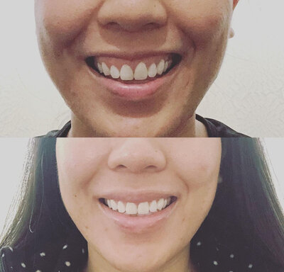 Before and after image showing gummy smile correction using neurotoxin injections at Refined Medical NY, relaxing the upper lip muscles to create a more balanced, natural-looking smile.