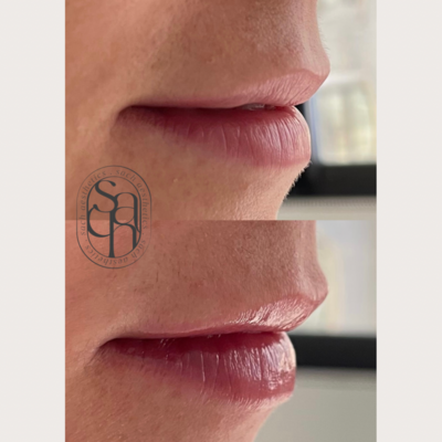 lip filler before and after on smaller, thin lips
