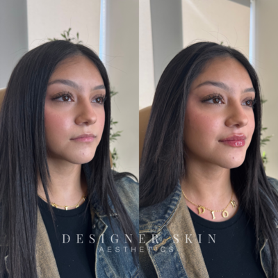Close-up of natural lip enhancement with dermal filler in Orange County
