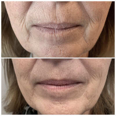 Lipfillers door cosmetisch arts Lizenka Adriaanse in Rotterdam