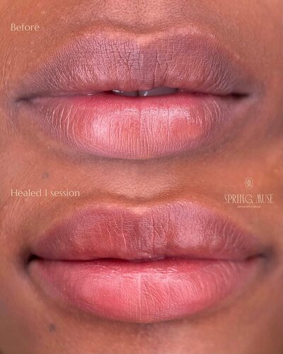 Healed Lip Neutralization nyc