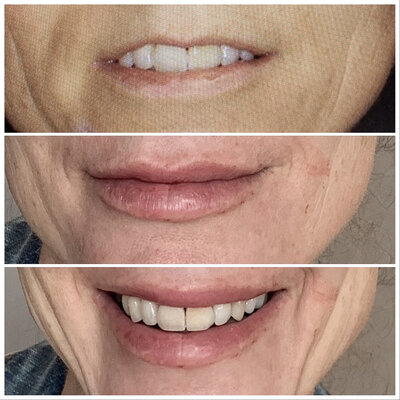 Lipfillers door cosmetisch arts Lizenka Adriaanse in Rotterdam