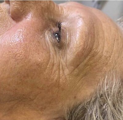 avant après cure jet peel effet antiage