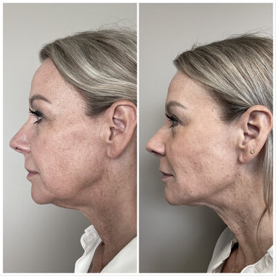 Before after liquid facelift Lizenka Adriaanse cosmetisch arts Rotterdam
