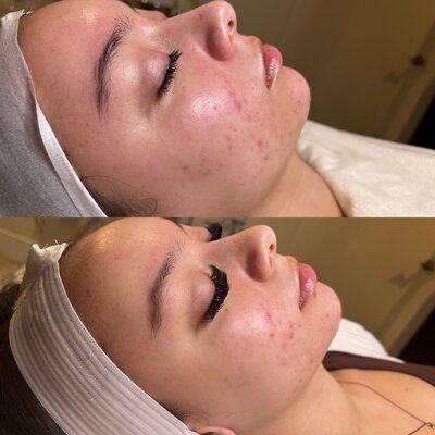 acne treatment 1 session1