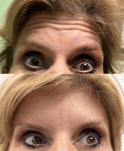 Botox injections before and after photo
