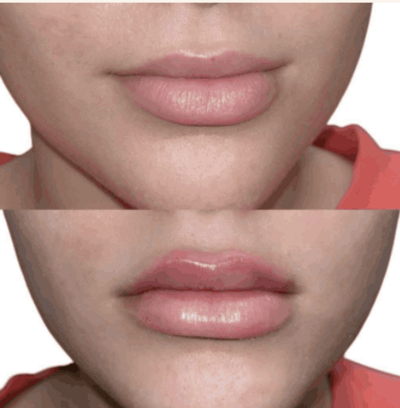 Lip injections before and after photo
