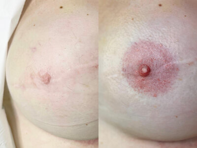 Paramedical tattoo of post-mastectomy scars by Vamp Cosmetic