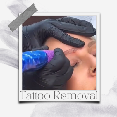 Saline Tattoo Removal