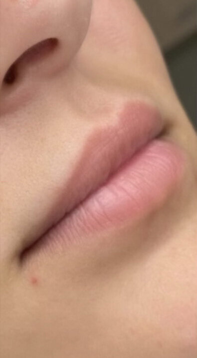 LipsBefore1